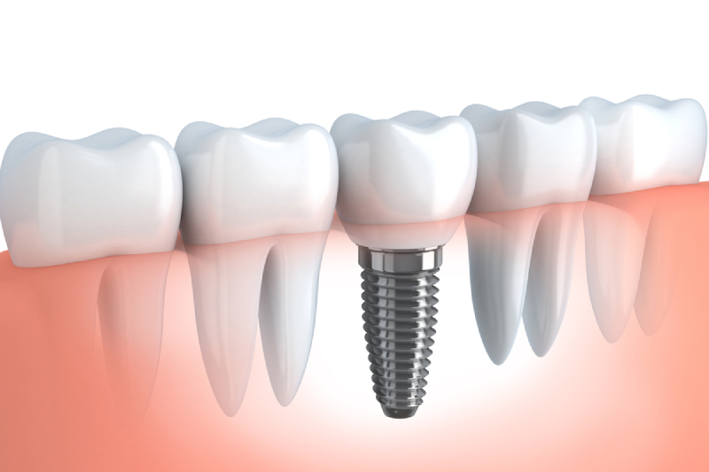 Implant Dentist in Temecula