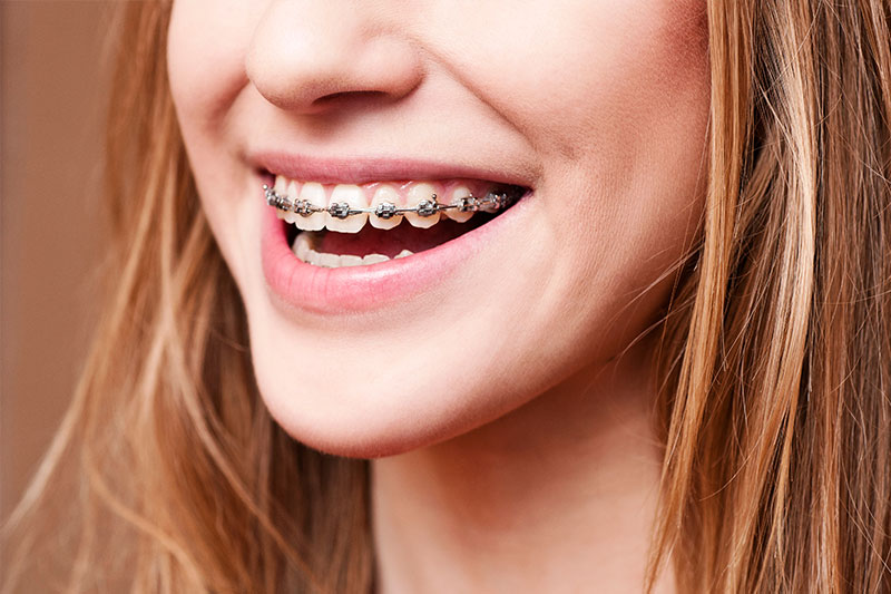 Orthodontics in Temecula